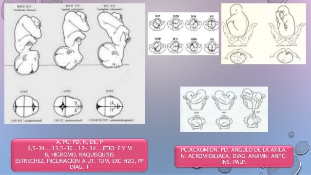 distocias de origen fetal
